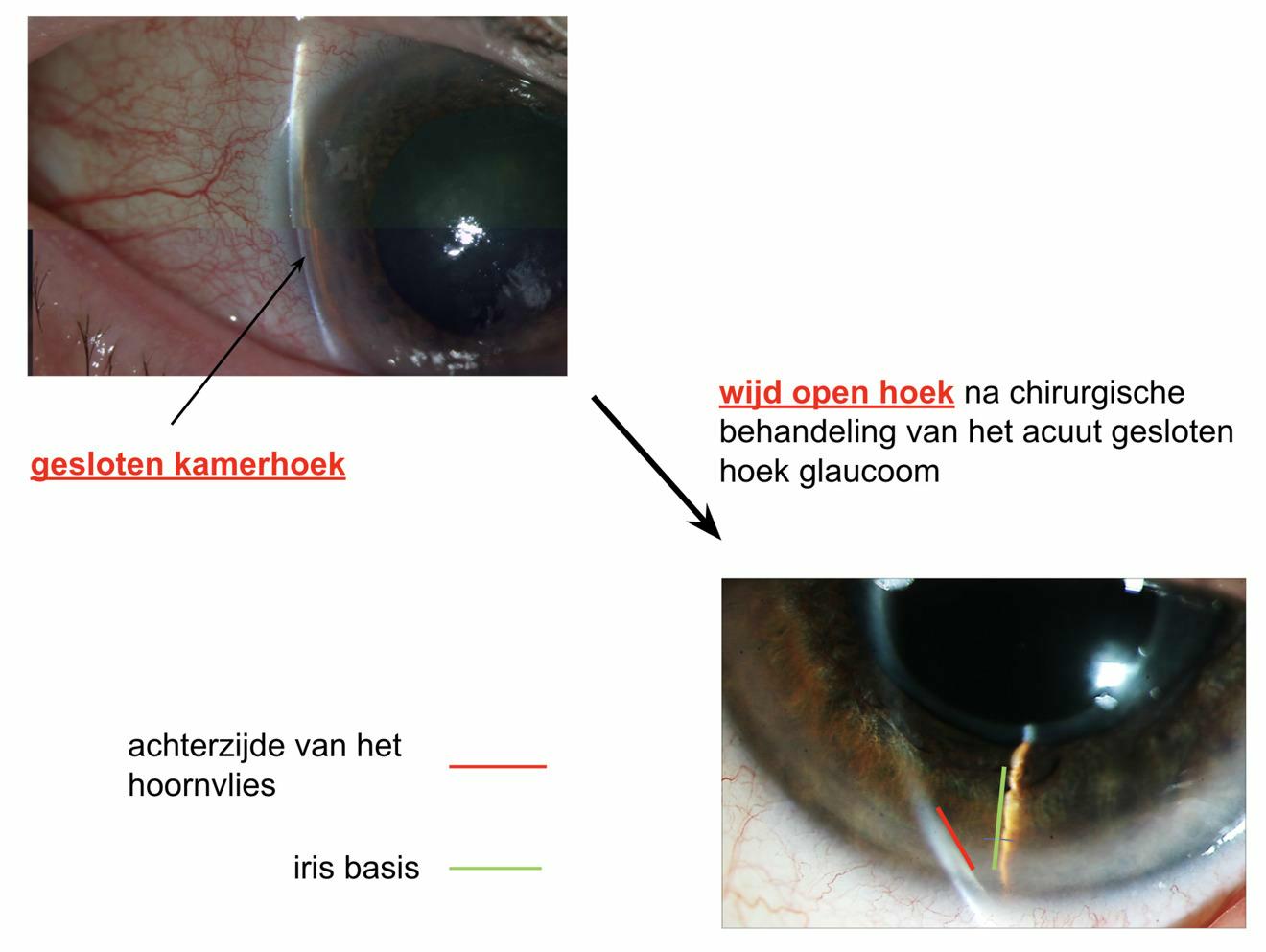 Acuut gesloten hoek glaucoom na behandeling